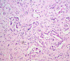 Liver: Angiosarcoma