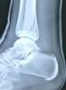 crop of spiral fracture of Fibula x-ray (day 12)