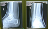 Spiral fracture of Fibula x-ray (day 12)