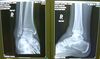 spiral fracture of Fibula x-ray (day 1)