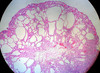 Fundic Gland Polyp, Stomach