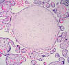Cartilaginous metaplasia in placenta (?) 1